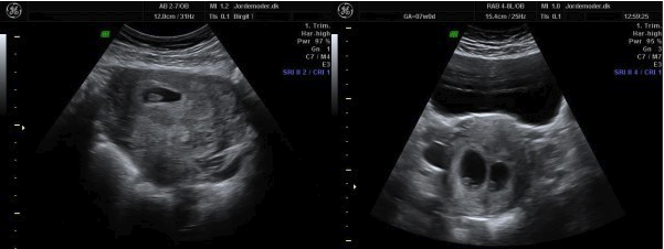 Scanning gravid uge 7 lille hjerte