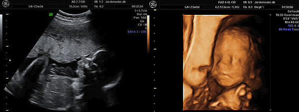 Scanning gravid uge 23 baby i livmoderen