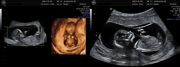 Scanning gravid uge 14 dit foster livmoderen