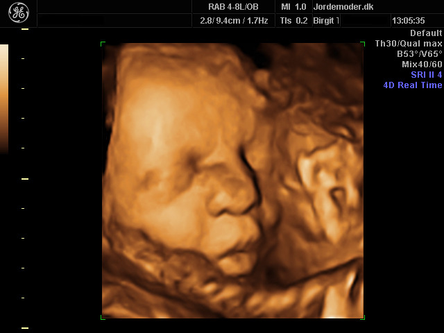 Scanning gravid uge 34